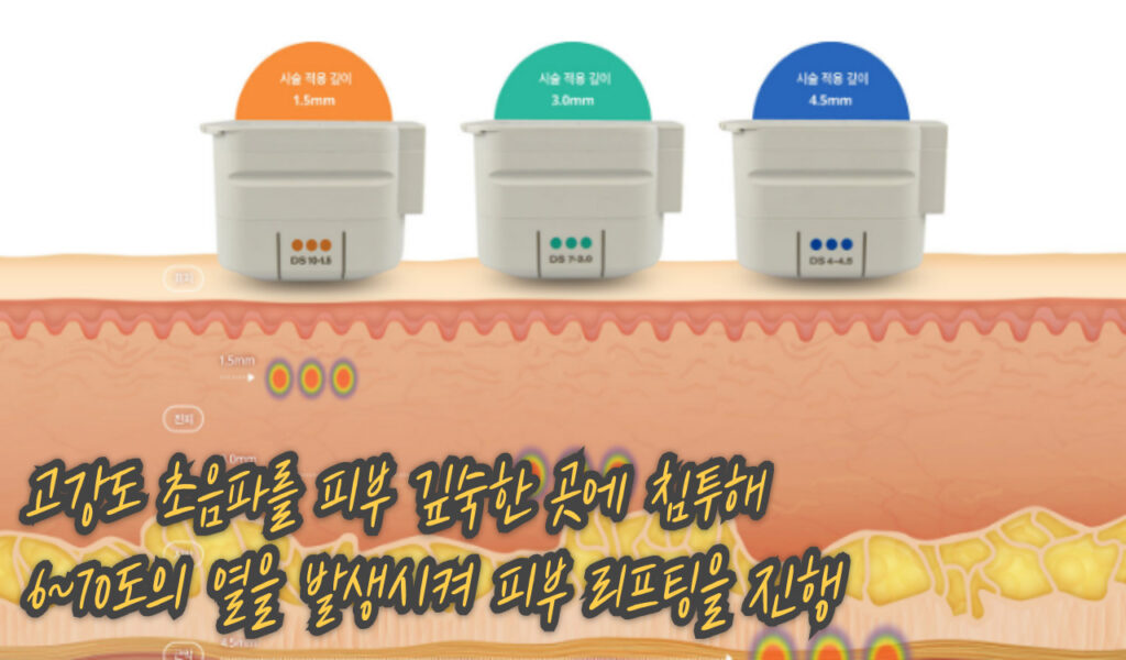 울쎄라 300샷 vs 600샷 다른 결과? 효과, 비용 차이와 선택방법 6 울쎄라 원리