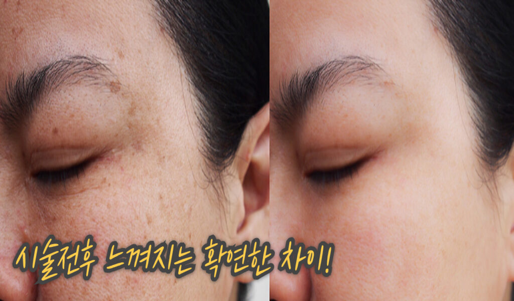 4만 8천원에 피부나이가 거꾸로? 40대 여성의 프락셀 비용 후기 7 전후차이