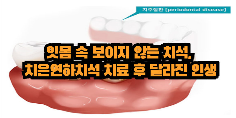 치주질환 치료방법