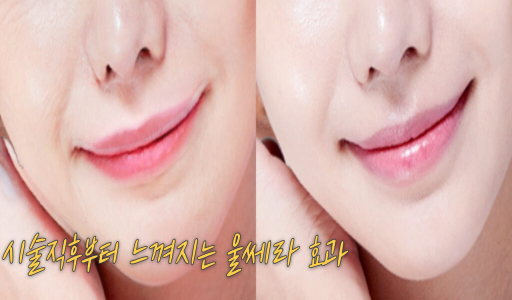 울쎄라 300샷 vs 600샷 다른 결과? 효과, 비용 차이와 선택방법 8 효과 1